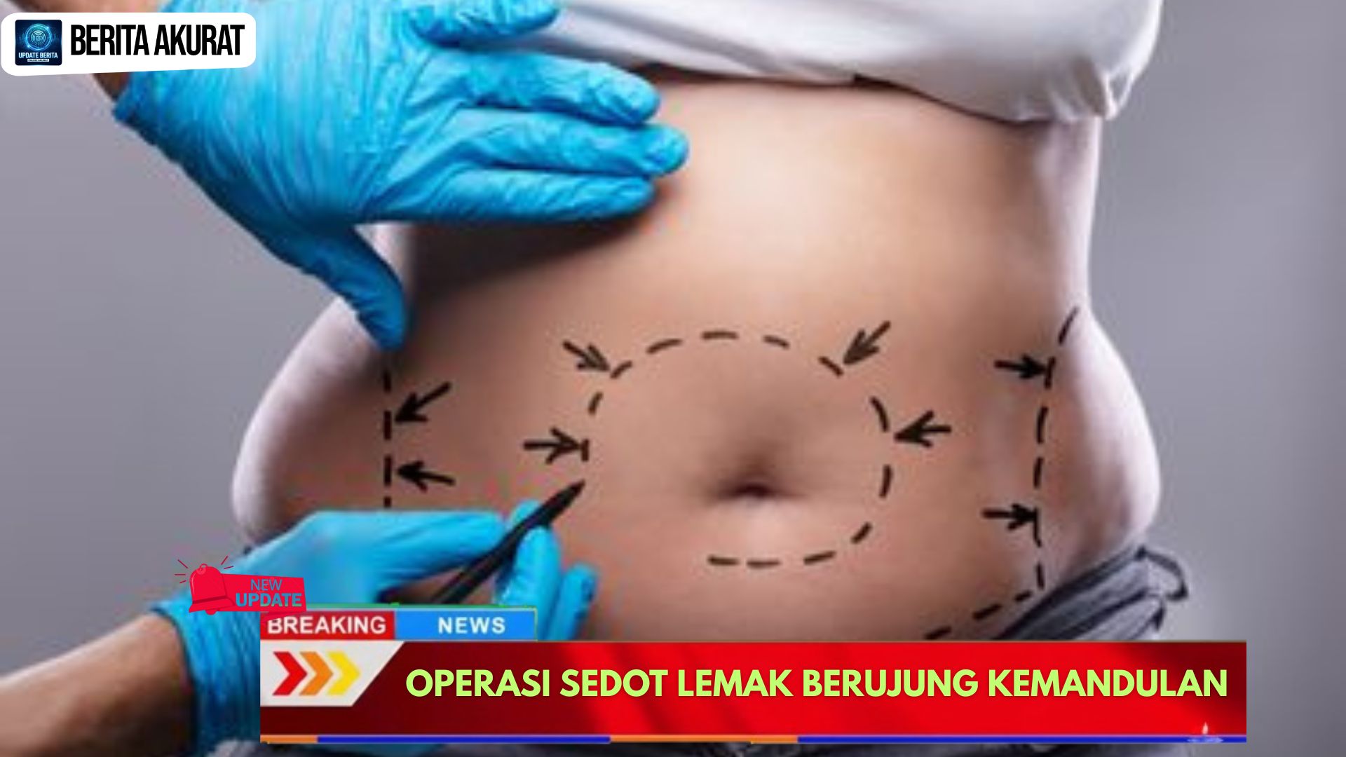 Operasi Sedot Lemak Berujung Kemandulan